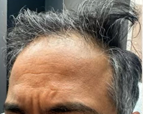 exosomes hair before